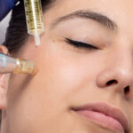 Microneedling mit PRP im Selbsttest