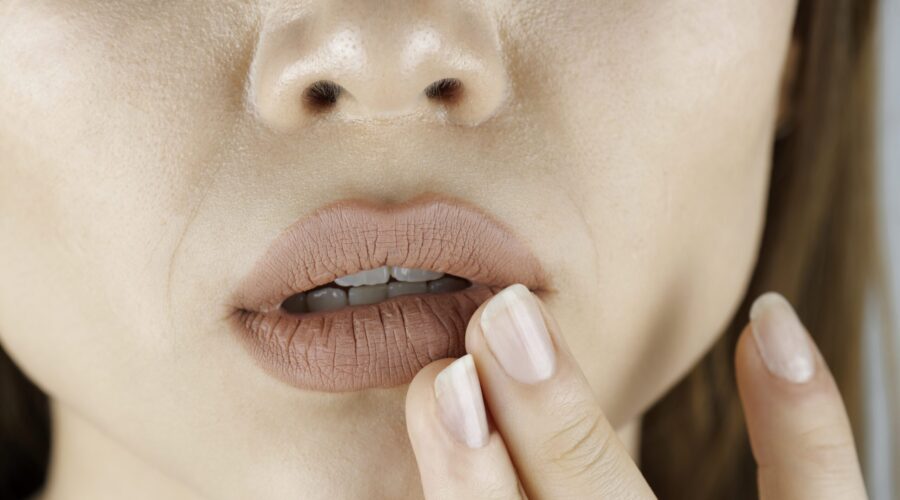 Lysin: Hilft die Aminosäure gegen Herpes?