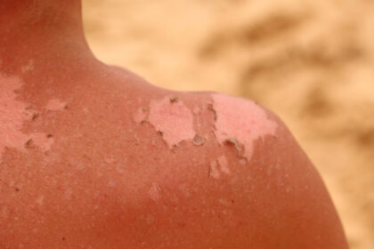 Sonnenbrand zweiten Grades - Was tun?