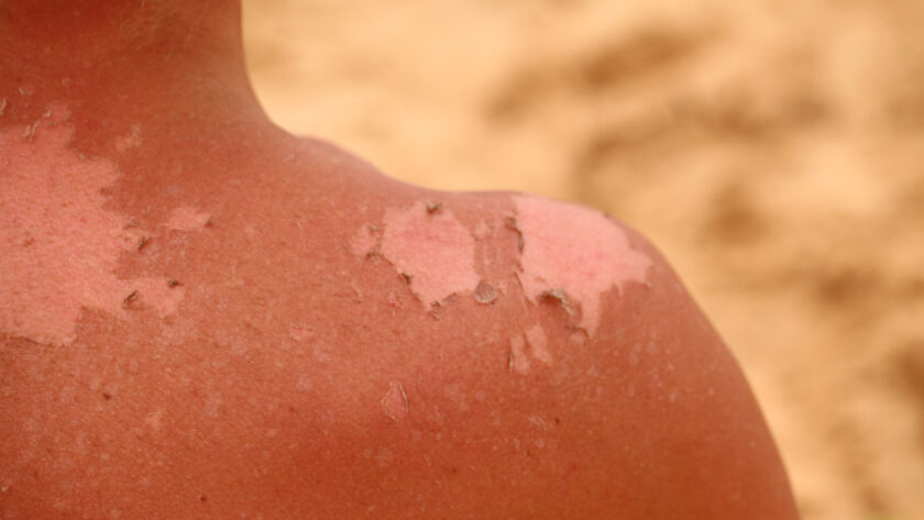 Sonnenbrand zweiten Grades - Was tun?