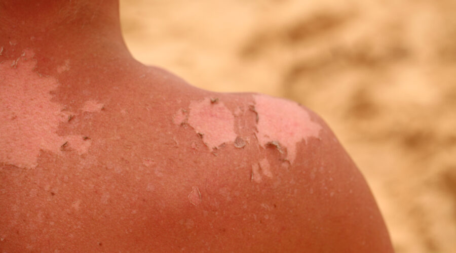 Sonnenbrand zweiten Grades - Was tun?