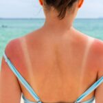 Sonnenbrand ersten Grades