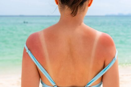 Sonnenbrand ersten Grades