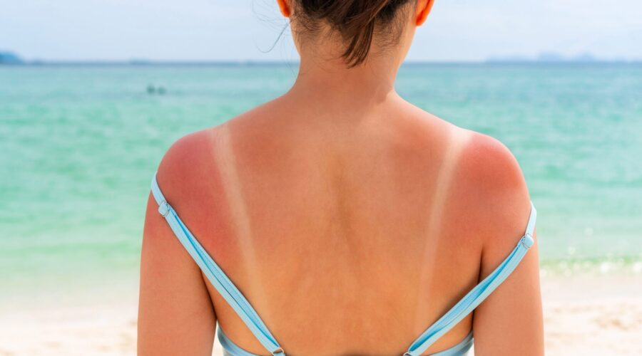 Sonnenbrand ersten Grades