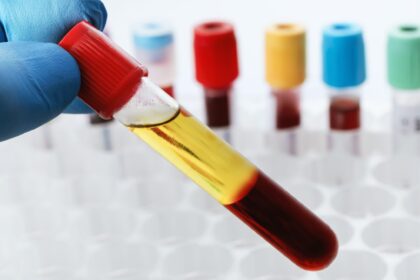 Bluttest für Vitaminwerte: Wann ist es sinnvoll?