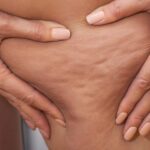 Alles was du über Cellulite wissen musst