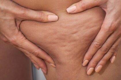 Alles was du über Cellulite wissen musst