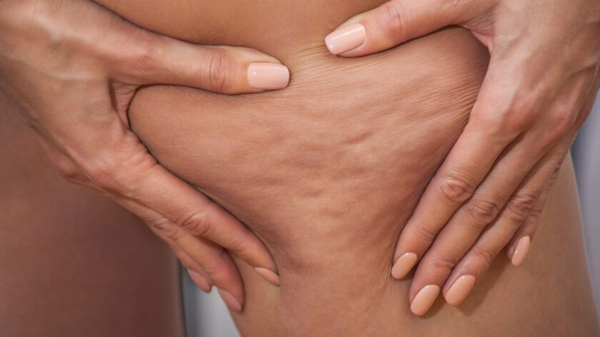 Alles was du über Cellulite wissen musst