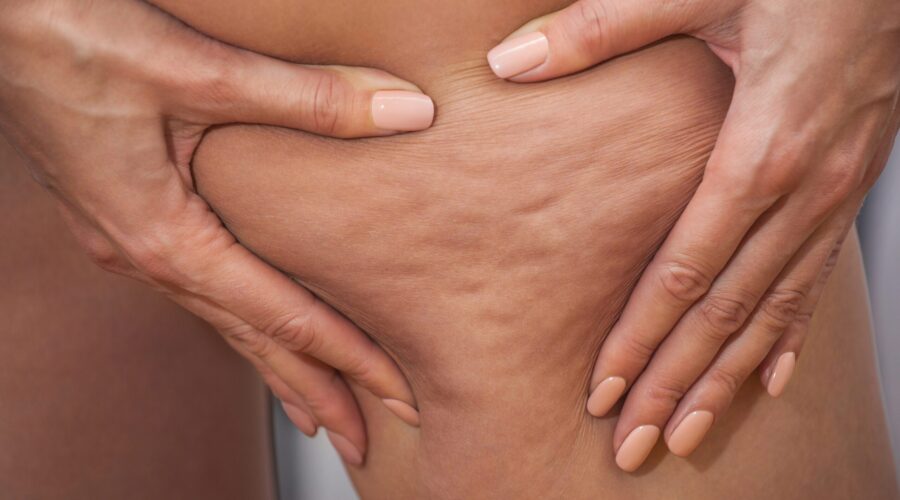 Alles was du über Cellulite wissen musst
