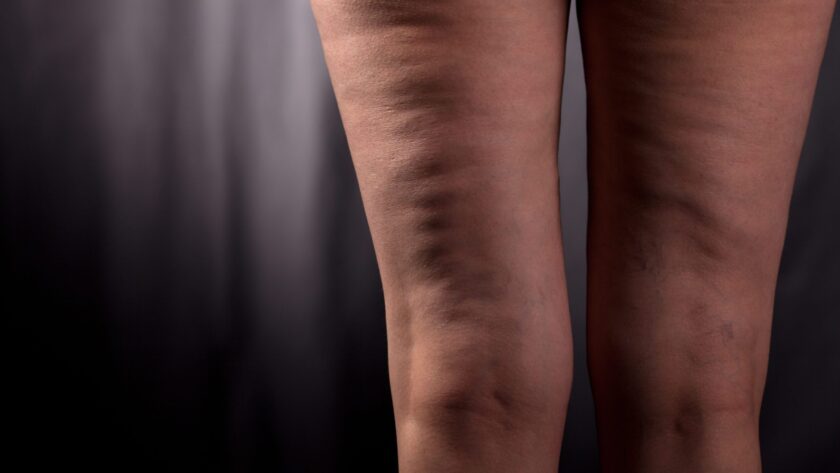 Cellulite vs. Lipödem: Was ist was?