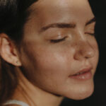 geschlossene Komedonen