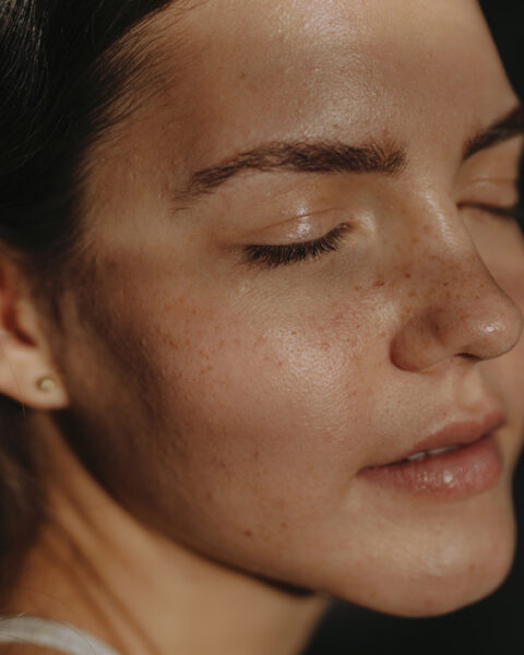 geschlossene Komedonen