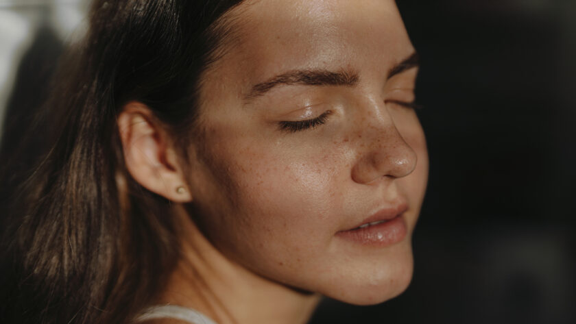 geschlossene Komedonen