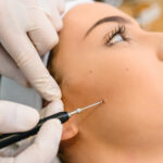 Stielwarzen entfernen