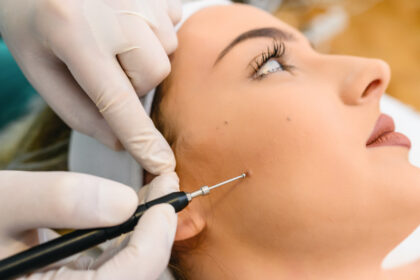 Stielwarzen entfernen