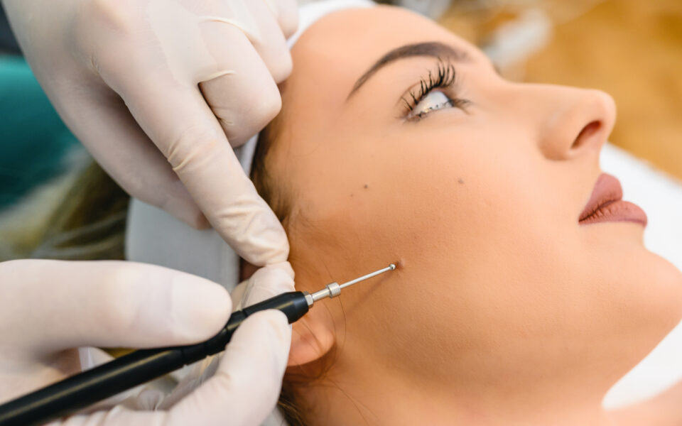 Stielwarzen entfernen